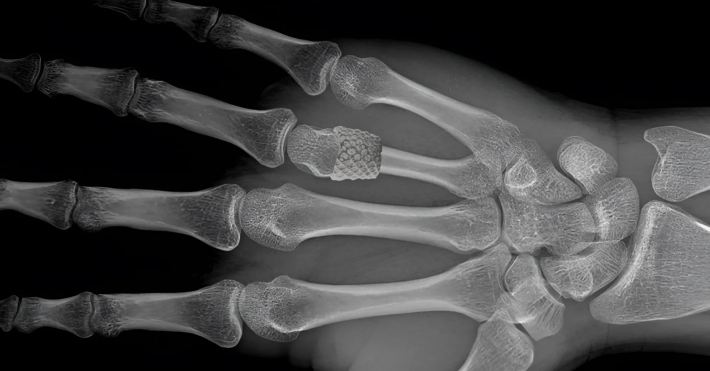 Medicine is evolving at an incredible pace, and biomaterials—innovative materials designed for medical use—are at the forefront of this transformation. New breakthroughs are improving biocompatibility, durability, and functionality, leading to better patient outcomes and redefining what’s possible in healthcare.